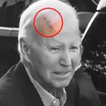 Joe Biden Scar on Head