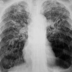 Tuberculosis Cases in Maine